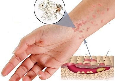 Events of the presence of subcutaneous pests in man