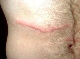 How to get rid of subcutaneous parasites to people