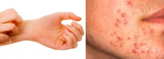 Symptoms of subcutaneous pests to people