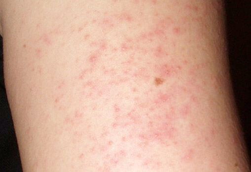Itchy rashes on the skin are a symptom of the presence of worms in the liver